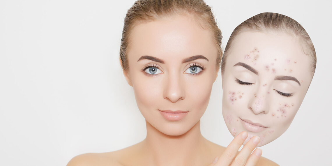 10 Ways of Fighting Pimples with Tulsi & Turmeric