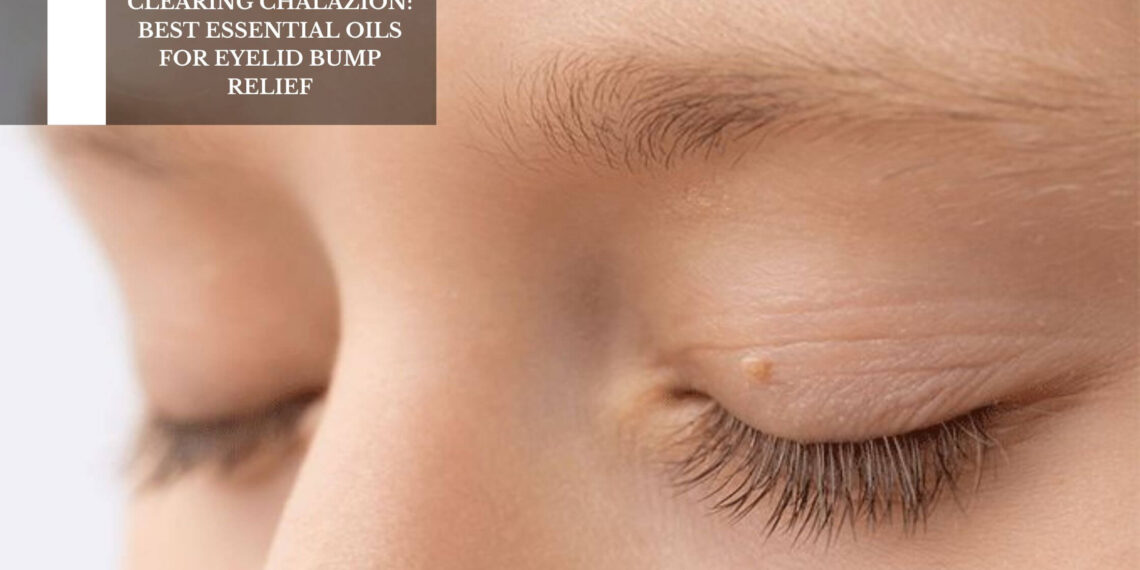Best Essential Oils For Eyelid Bump Relief
– Moksha Lifestyle Products