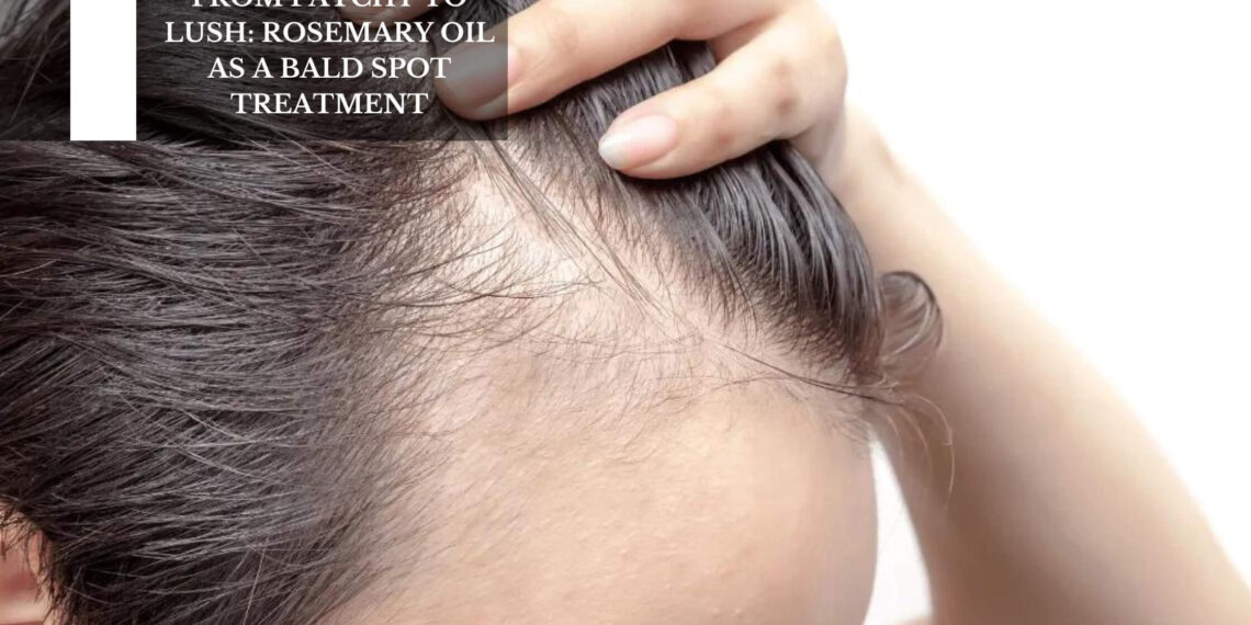 Rosemary Oil As A Bald Spot Treatment
– Moksha Lifestyle Products