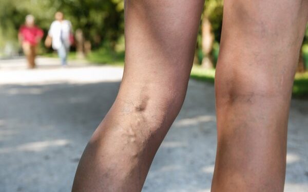 8 Beneficial Health Tips for Varicose Veins