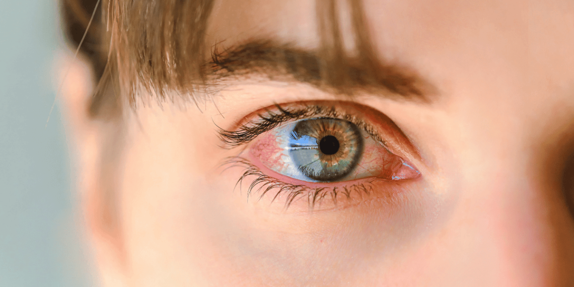 Home Remedies For Pink Eye