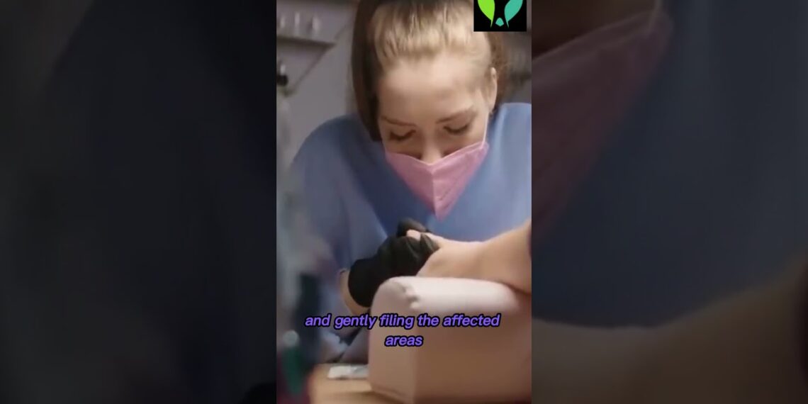 Say Goodbye to Nail Fungus Effective Home Remedies with Tea Tree Oil and Lemon Juice!