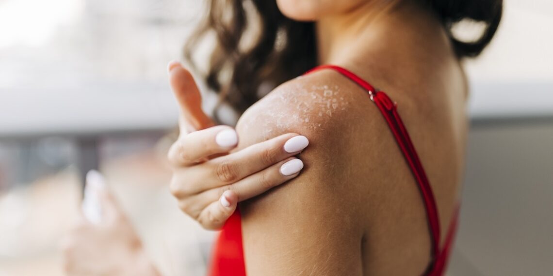 Heat Rash vs Sun Poisoning: Symptoms, Differences & Tips
