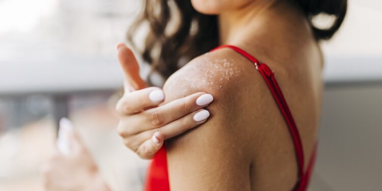 Heat Rash vs Sun Poisoning: Symptoms, Differences & Tips