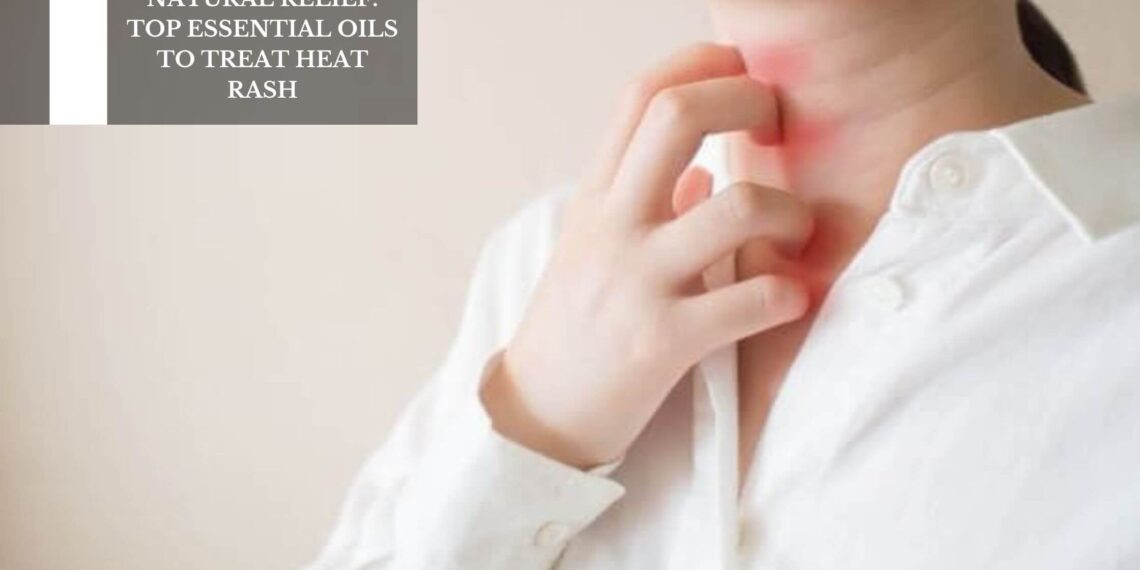 Top Essential Oils To Treat Heat Rash
– Moksha Lifestyle Products