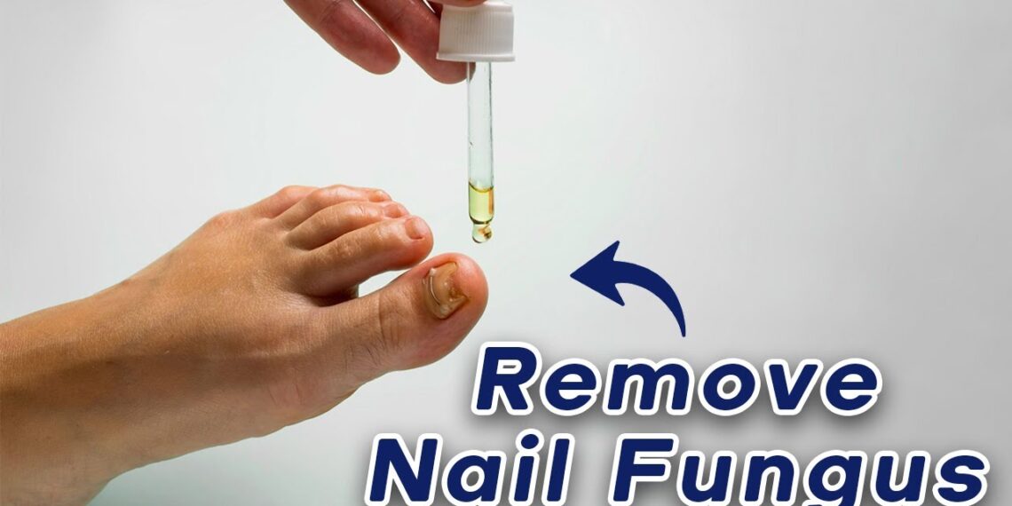 Unleash the Power of Nature: Say Goodbye to Nail Fungus!