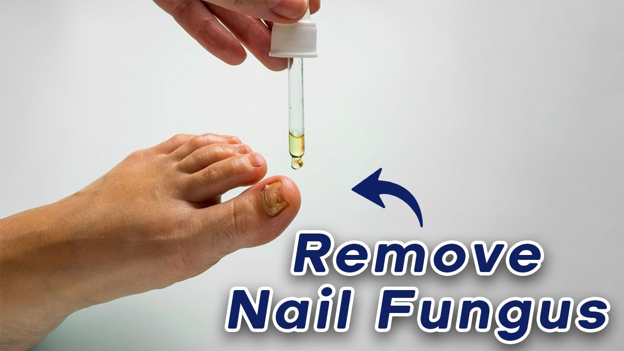 Unleash the Power of Nature: Say Goodbye to Nail Fungus!