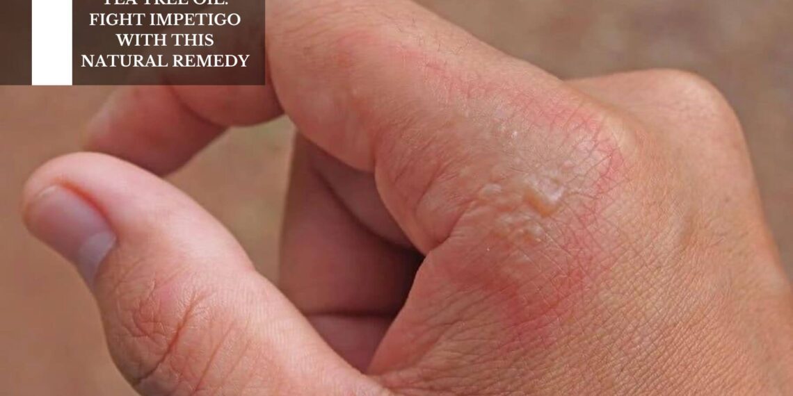 Fight Impetigo With This Natural Remedy
– Moksha Lifestyle Products