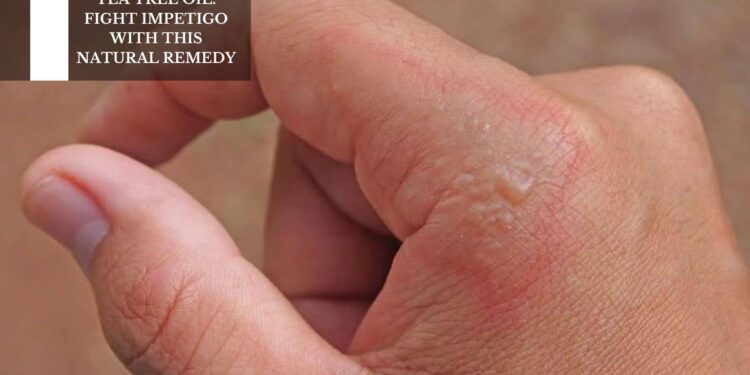 Fight Impetigo With This Natural Remedy
– Moksha Lifestyle Products