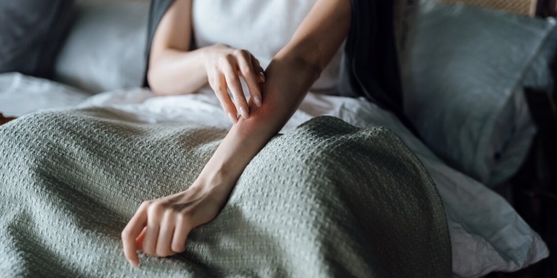 Autoimmune Progesterone Dermatitis: Period Allergy Causes