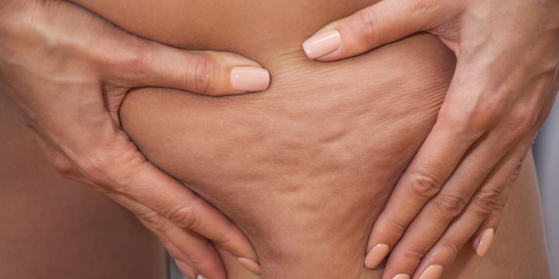 Chokeberry & tart cherry supplement can reduce cellulite