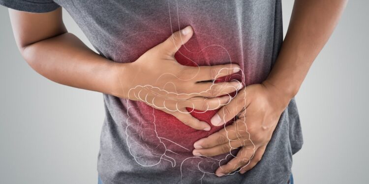 Chestnut and quebracho supplement may improve IBS symptoms