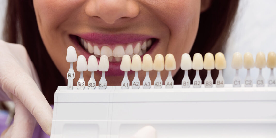 Transforming London Smiles: The Veneer Advantage