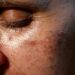 Can supplements protect against UV-induced skin damage?